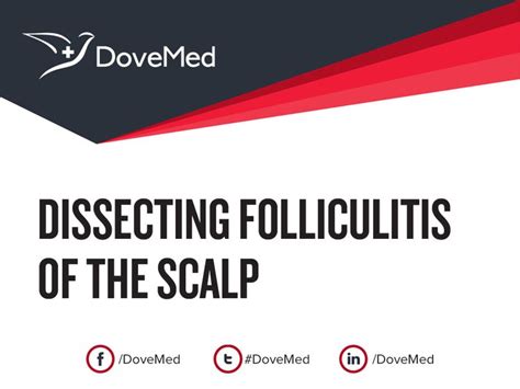 Dissecting Folliculitis Of The Scalp