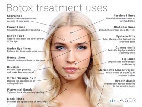 Botox Injection Sites Botox Injections Botox Fillers Dermal Fillers