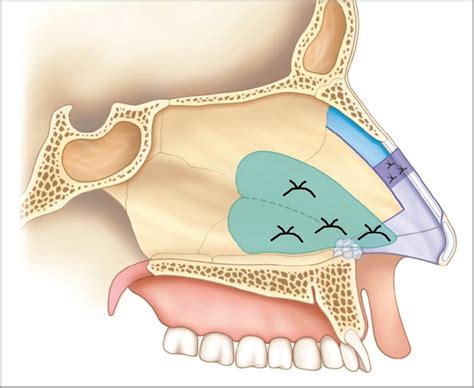 A New Nasal Septum Splint Jama Facial Plastic Surgery The Jama Network