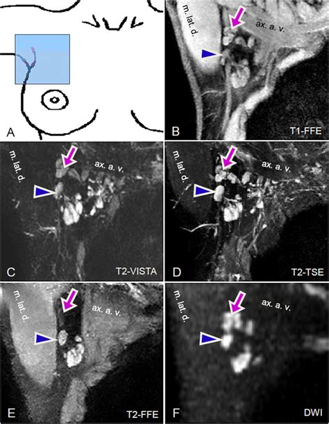 Coronal Slices Showing Right Sided Axillary Lymph Nodes Lns In One