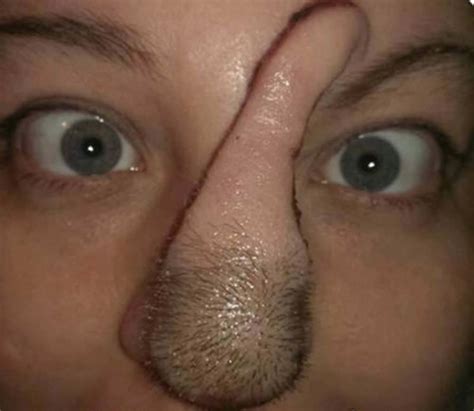 Some may be normal but a persistent black spot that is itchy and grows into a lump or bump could mean cancer. Woman With Skin Cancer Given New Nose Using Flesh From Her ...