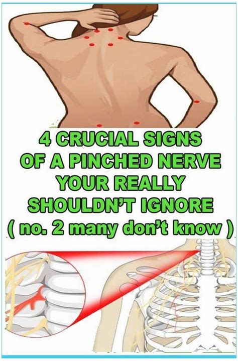 4 Crucial Signs Of A Pinched Nerve You Really Shouldt Ignore Pinched