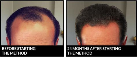 Imuran (azathioprine), an immunosuppressant prescribed to people with ibd, lists hair loss as a common side effect. The Scalp Regeneration Method
