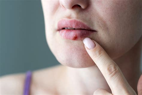 hpv mouth sores