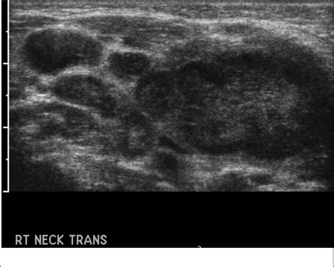 Neck Abscess Ultrasound
