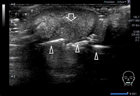 Sonogram Of The Lesion On The Lower Lip A Gray Scale And Transverse