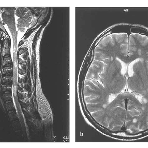 A T2 Weighted Sagittal MR Image Of Cervical Spine Multiple
