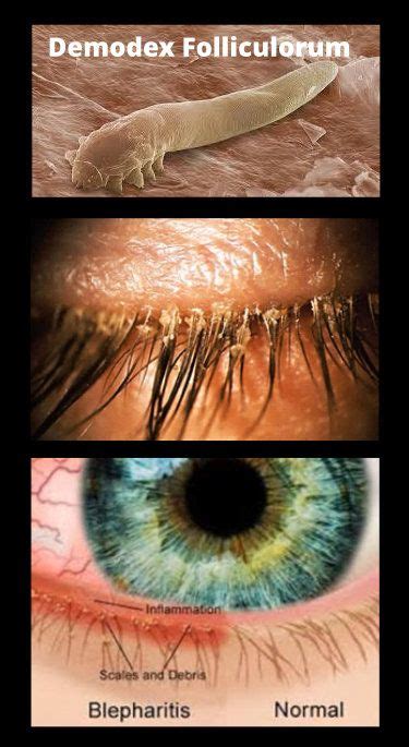 Eye Mites Demodex Mites Tea Tree Oil Shampoo Dry Eye Symptoms Eye