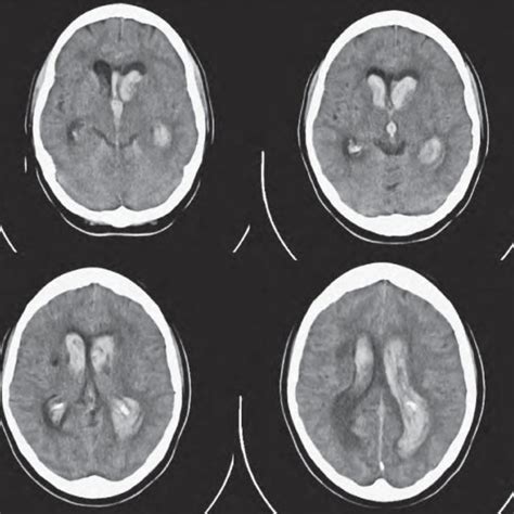 Axial Ct Scans On Admission Showing A Diffuse Intraventricular Hematoma