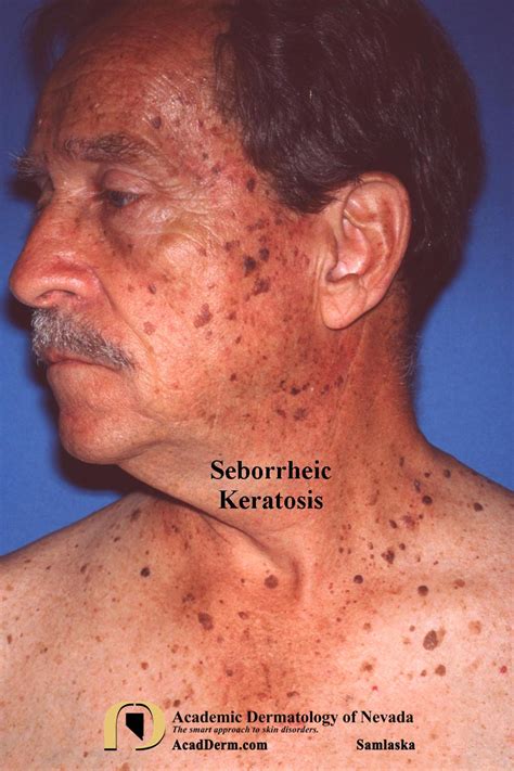 Seborrheic Keratosis Histology