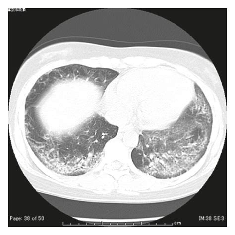 Chest Computed Tomography On Admission Showing Ground Glass Opacity