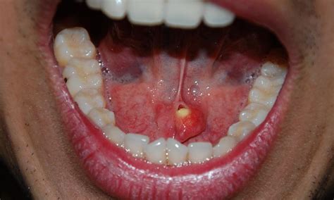Salivary Duct Stones Pictures