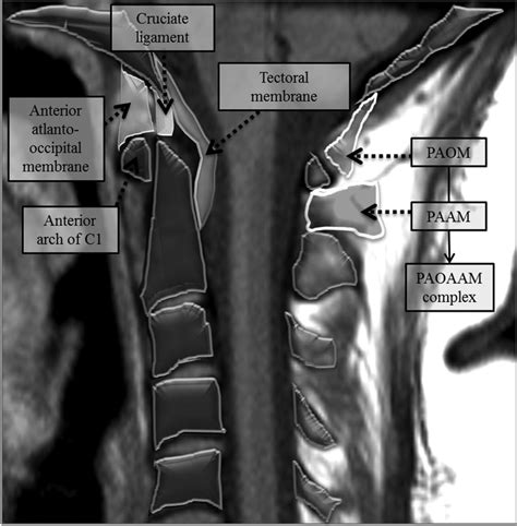 Ligamentum flavum hypertrophy, also known as ligamentum flavum thickening, is a health condition related to the spine and lower back. Diagnostic Utility of Increased STIR Signal in the ...