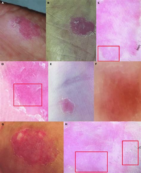 Clinical And Dermoscopic Features A And B Cases 1 And 2 Atrophic