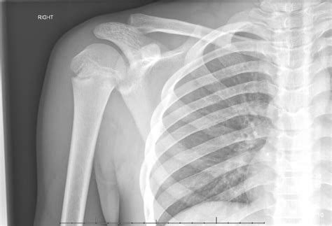 Recanting Impressions Posterior Sternoclavicular Joint Dislocation Emra