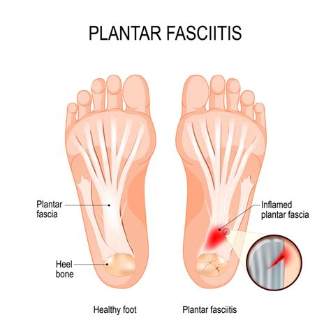 Managing Plantar Fasciitis Hempstead Therapy Centre