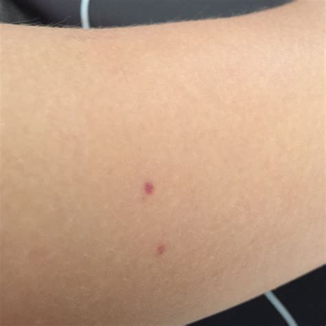 Zwei rote Punkte auf der Haut. Was ist das? (rot)