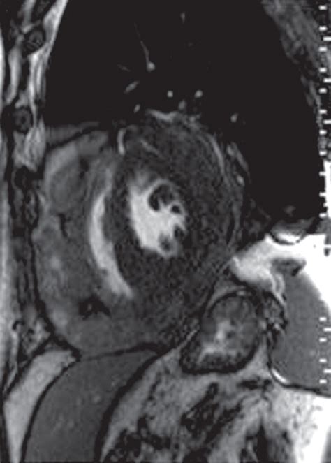 Primary Pericardial Tumors Radiographics