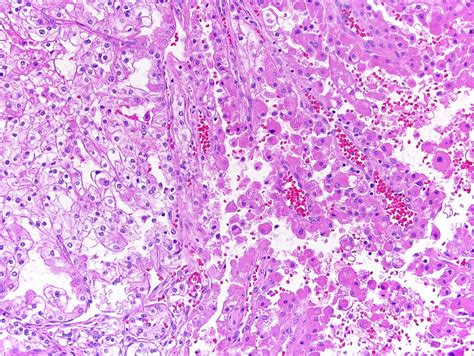 Pathology Outlines Eosinophilic Variant Of Clear Cell Renal Cell