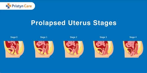 Prolapsed Uterus Stages B T Ch Xanh
