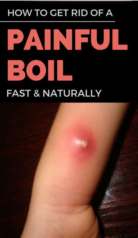 How To Get Rid Of A Painful Boil Fast And Naturally Healthy Lifestyle