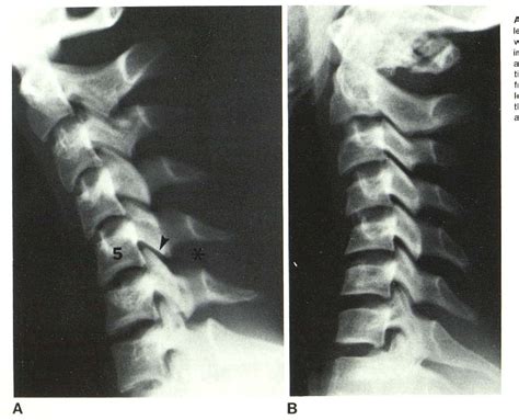 Pdf Anterior Subluxation Of The Cervical Spine Hyperflexion Sprain
