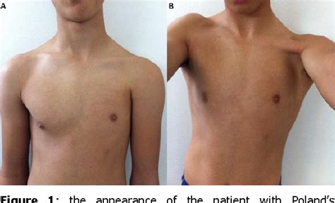 As noted above, poland syndrome affects the right side of the body in approximately 75 percent of cases. Figure 1 from Poland's syndrome | Semantic Scholar