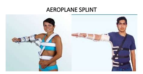 Aeroplane Splint Dnb Orthopaedics Ms Orthopedics Mrcs Exam Guide
