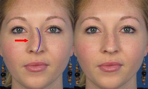 Crooked Nose Before And After Rhinoplasty Nose Surgery