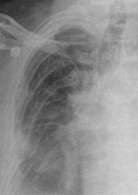 Pulmonary Edema Vs Normal Chest X Ray