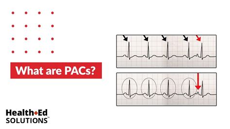 One Quick Question What Are Pacs Premature Atrial Contractions
