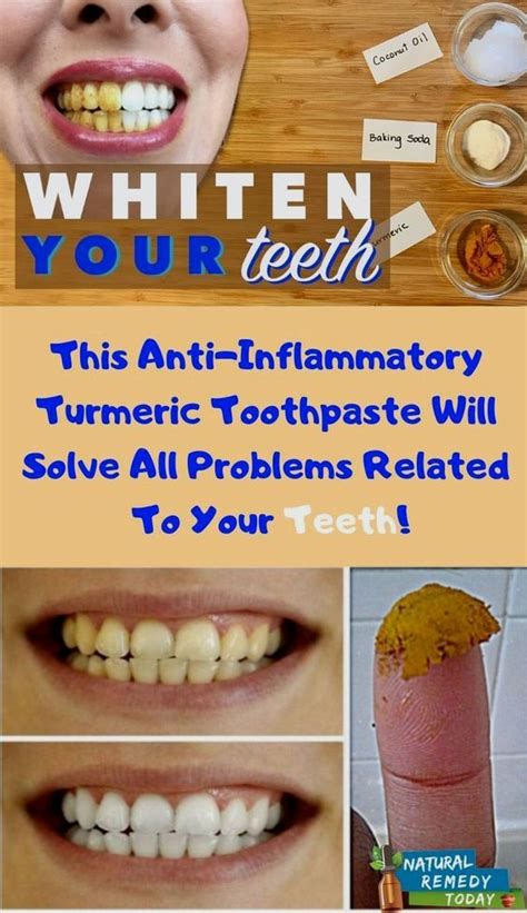 Pin On Teeth Whitening