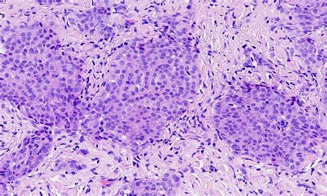 Histopathology is the largest specialty within pathology. Pathology Outlines - Case of the Week #476