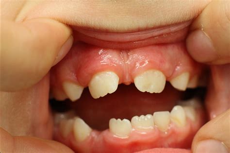 How Bacterial Plaque Causes Dental Caries And Tooth Decay Small Bites