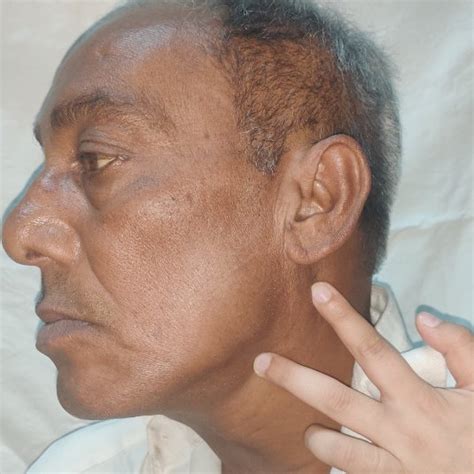 Clinical Picture Showing Left Side Cervical Swelling At The Level Ii A