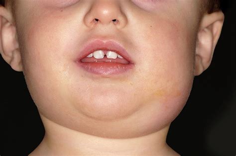 Mumps Photograph By Dr P Marazziscience Photo Library