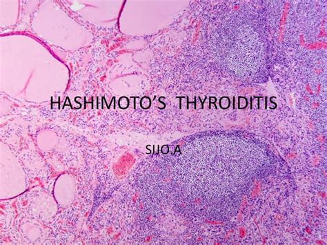 Hashimotos Thyroiditis Ppt