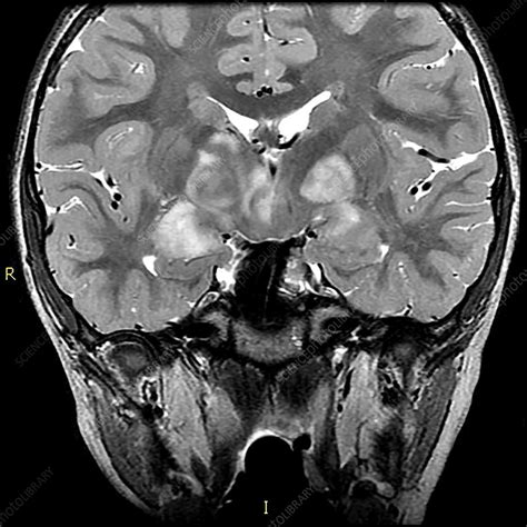 The specific genes involved depend on the type of. Neurofibromatosis type I (NF1), MRI - Stock Image - C036 ...