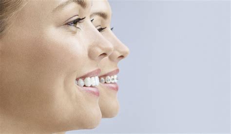 The Invisalign System 32 Smile Design Schofields Dentistry