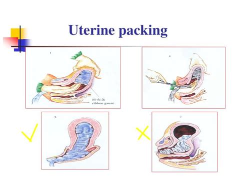 Ppt Post Partum Hemorrhage Uterine Rupture Powerpoint Presentation Id 5439144