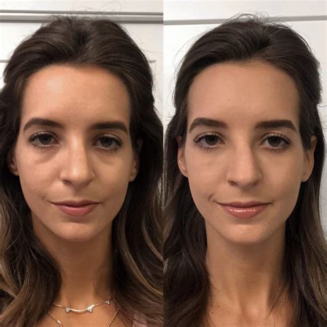 Under Eye Fillers Dark Circle Reduction Before And After Photos Dallas