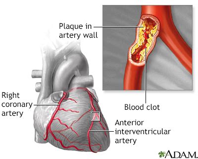 Coronary Artery Disease Symptoms And Causes Penn Medicine