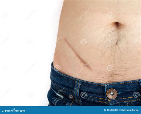 Closeup Of Man Showing The Stomach With A Scar From Appendicitis