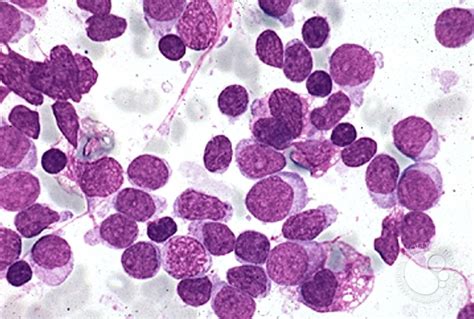 Precusor B Cell Acute Lymphoblastic Leukemia 8