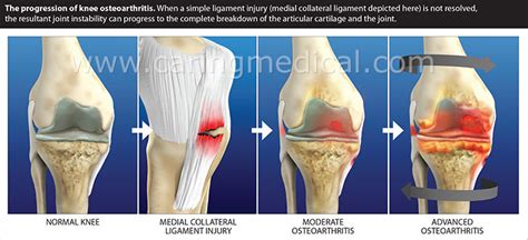 Treating Chronic Knee Swelling Knee Synovitis And Inflammation Without