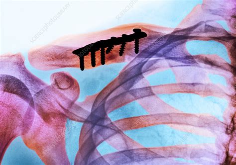 Pinned Collar Bone Fracture X Ray Stock Image M3301543 Science