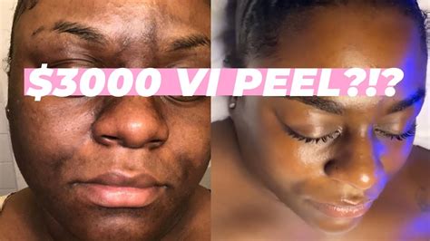 Before And After Chemical Peel Black Skin See The Wow Results