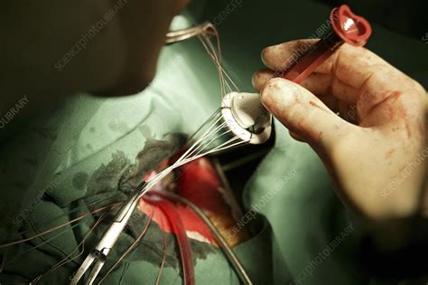 Heart Valve Surgery Stock Image M5610078 Science Photo Library