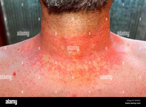 Dermititis Should Be Dermatitisred Skin Rash On A Man´s Neck And Chest