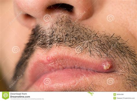 The best treatment for a pimple in nose depends on the. Pelo incarnito fotografia stock. Immagine di boil, umano ...